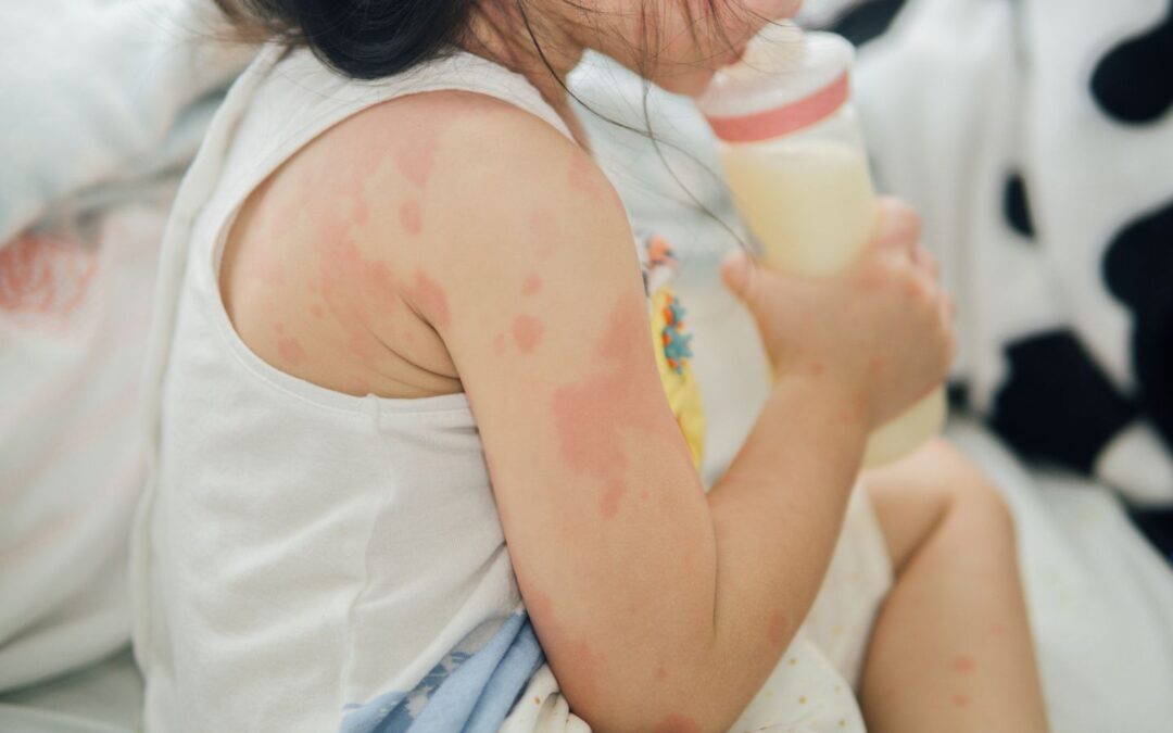 Water Allergies in Infants: Signs, Symptoms, and Solutions