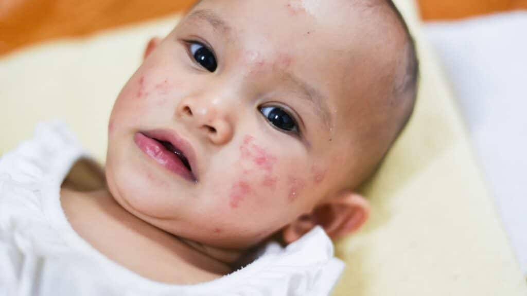 Wate allergies of an infant.